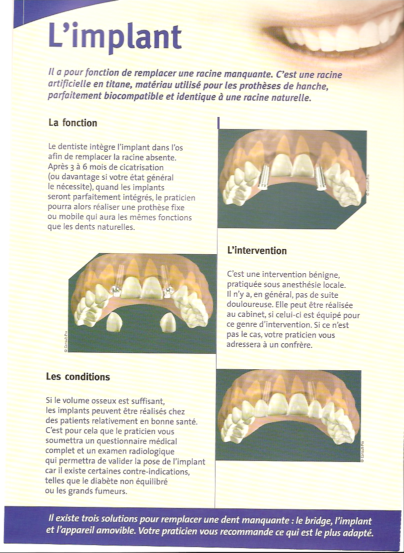 Prothèse Dentaire Amovible : Remplacer par un Implant